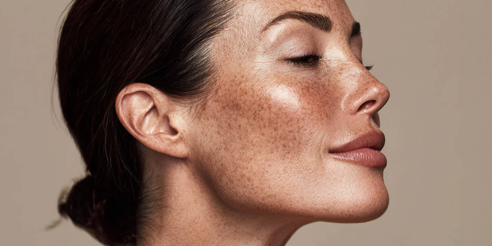 Hyperpigmentation
